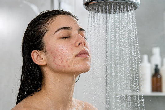 does hard water cause acne